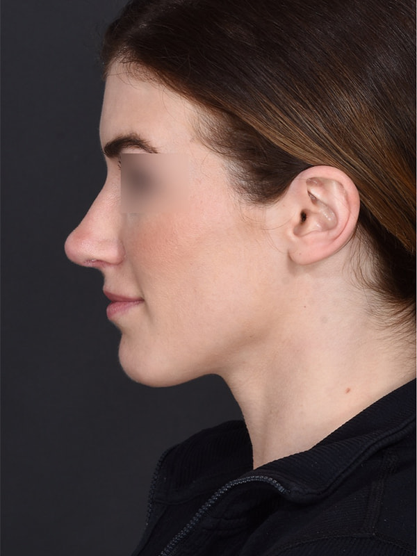 Rhinoplasty Before & After Image