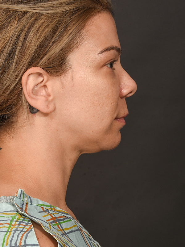 Rhinoplasty Before & After Image