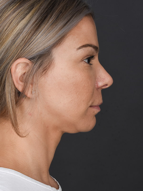 Rhinoplasty Before & After Image