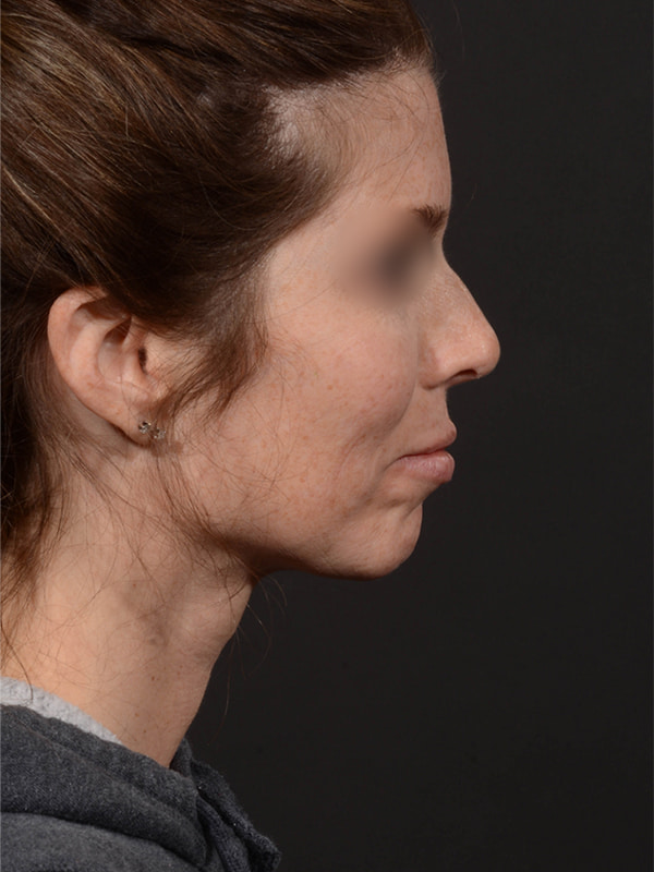 Rhinoplasty Before & After Image