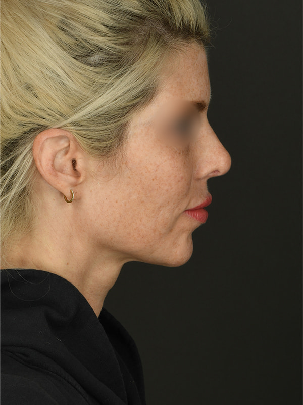 Rhinoplasty Before & After Image