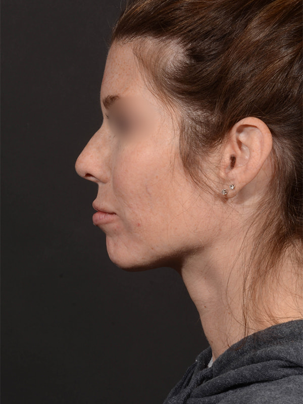 Rhinoplasty Before & After Image