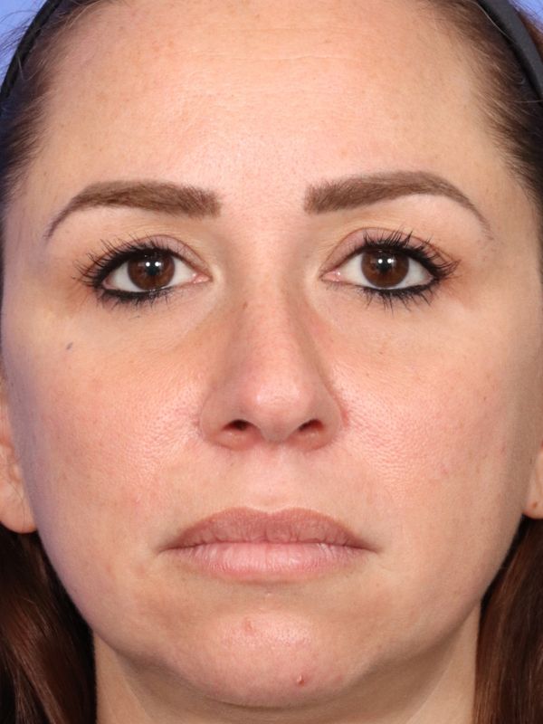 Rhinoplasty Before & After Image
