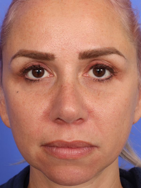 Rhinoplasty Before & After Image