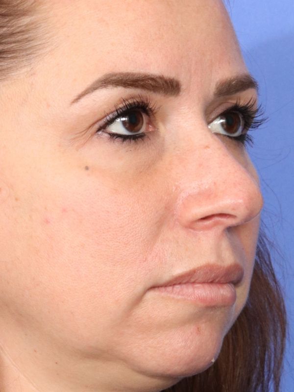 Rhinoplasty Before & After Image