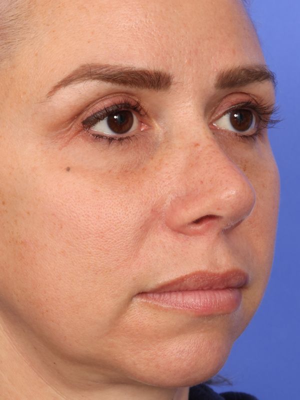 Rhinoplasty Before & After Image