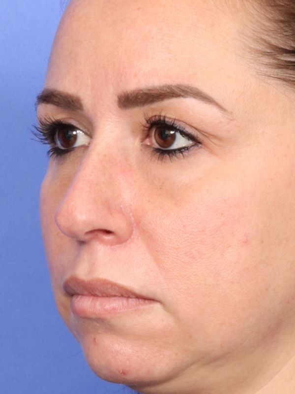 Rhinoplasty Before & After Image