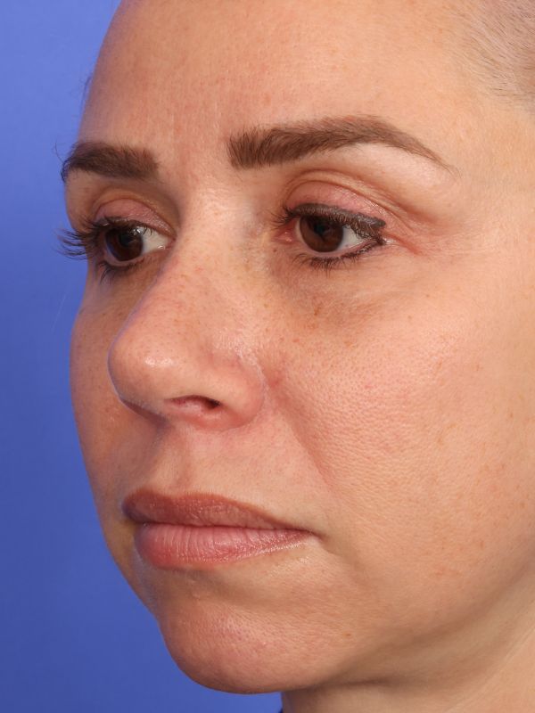 Rhinoplasty Before & After Image