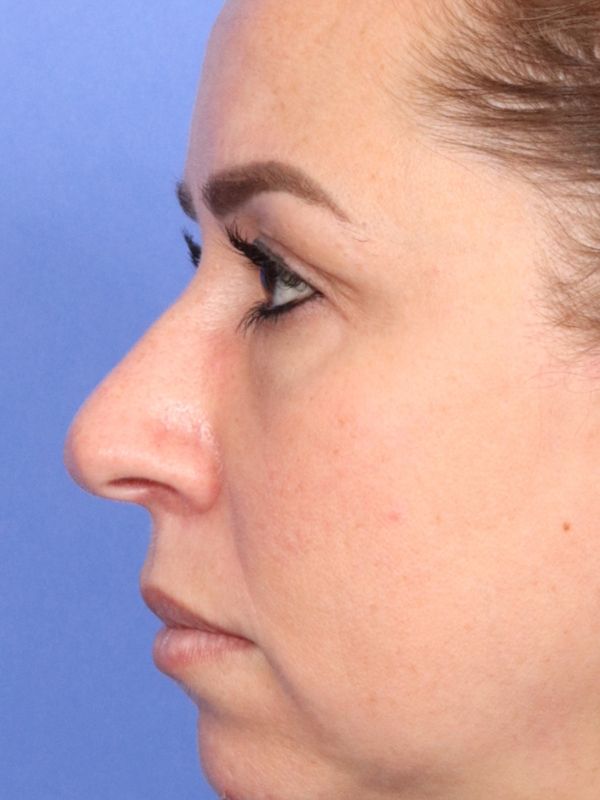 Rhinoplasty Before & After Image