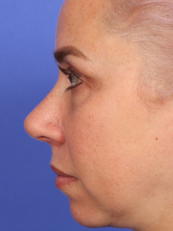 Rhinoplasty Before & After Image