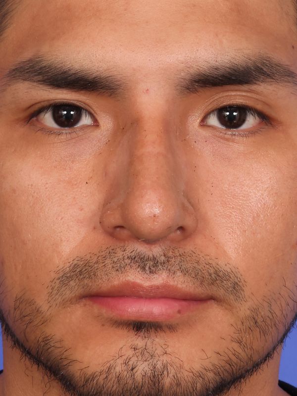 Rhinoplasty Before & After Image