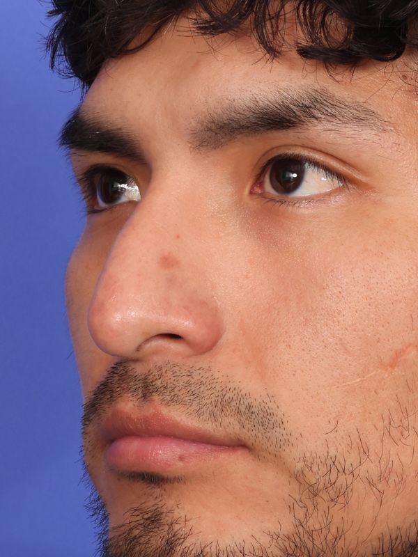 Rhinoplasty Before & After Image