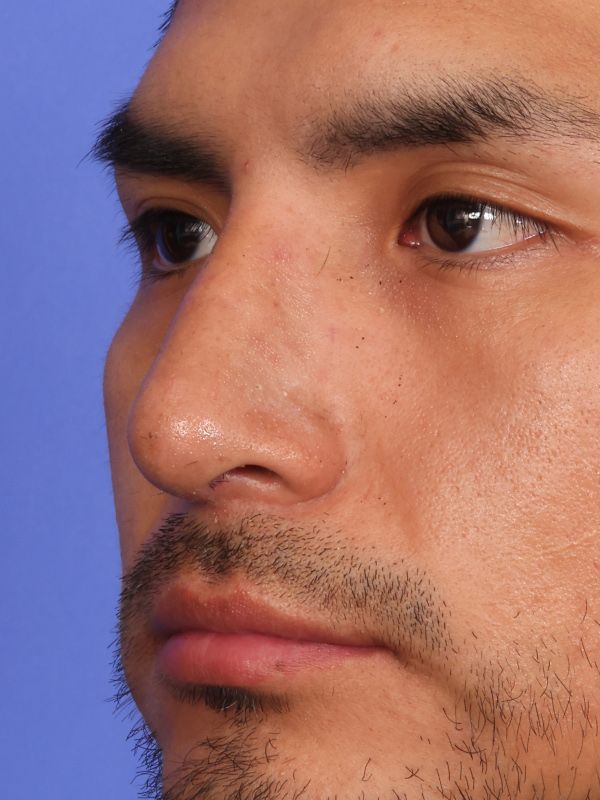 Rhinoplasty Before & After Image