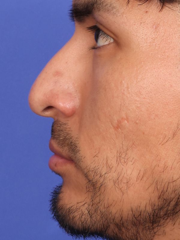 Rhinoplasty Before & After Image