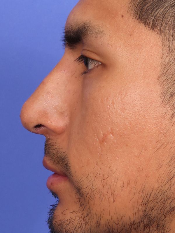 Rhinoplasty Before & After Image