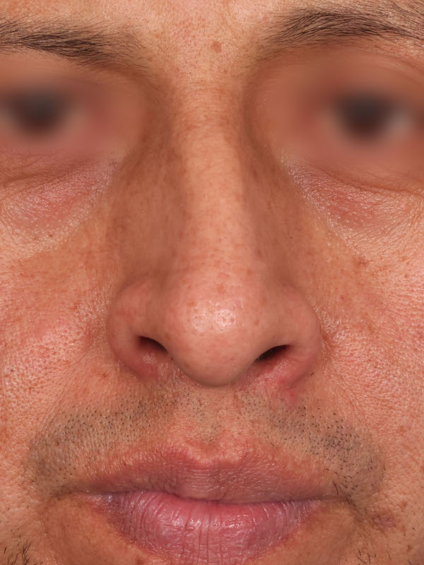 Rhinoplasty Before & After Image