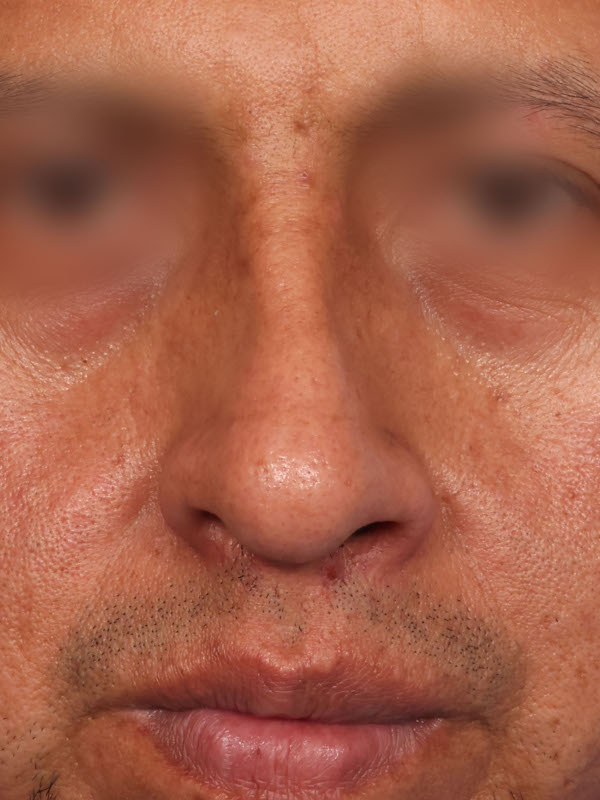 Rhinoplasty Before & After Image