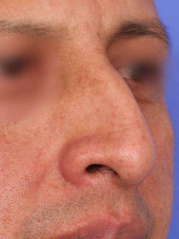 Rhinoplasty Before & After Image