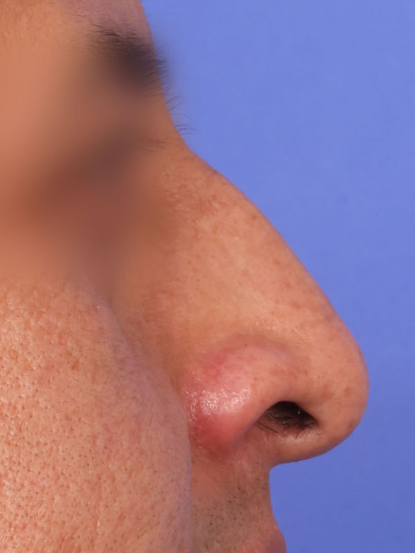 Rhinoplasty Before & After Image