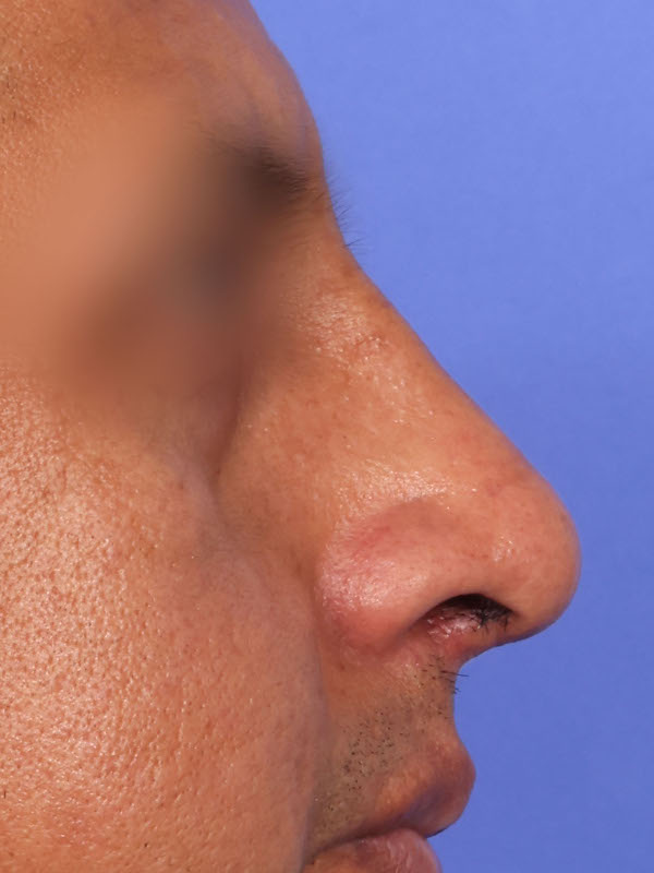 Rhinoplasty Before & After Image