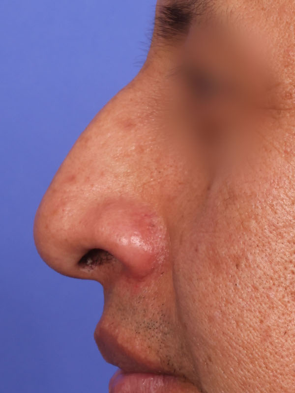Rhinoplasty Before & After Image