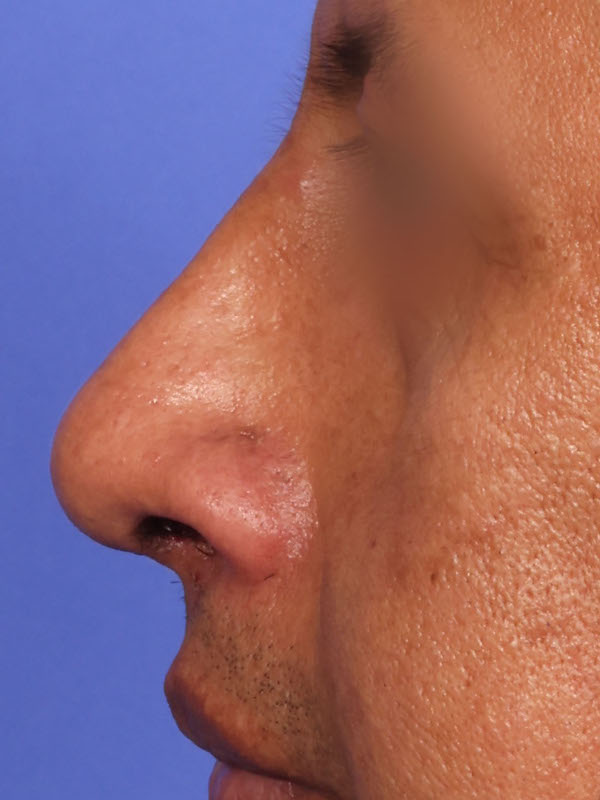Rhinoplasty Before & After Image