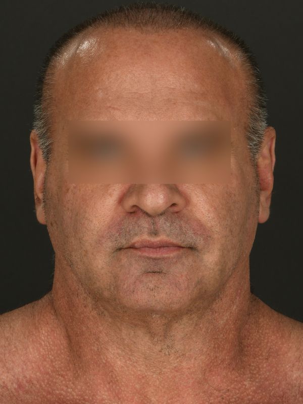 Suture Suspension Neck Lift Before & After Image
