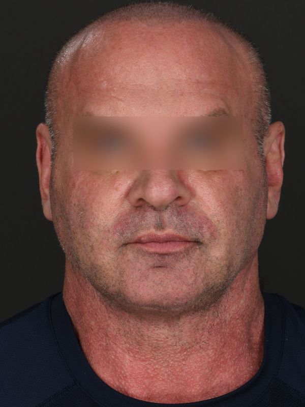 Suture Suspension Neck Lift Before & After Image