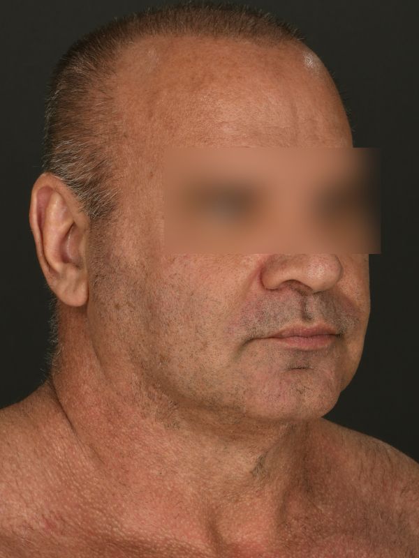 Suture Suspension Neck Lift Before & After Image
