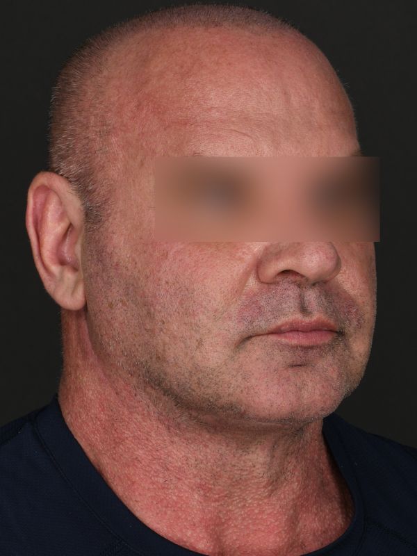 Suture Suspension Neck Lift Before & After Image