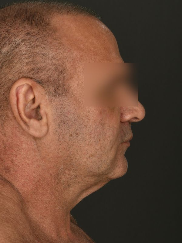 Suture Suspension Neck Lift Before & After Image