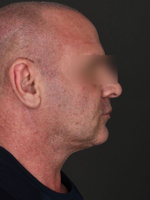 Suture Suspension Neck Lift Before & After Image
