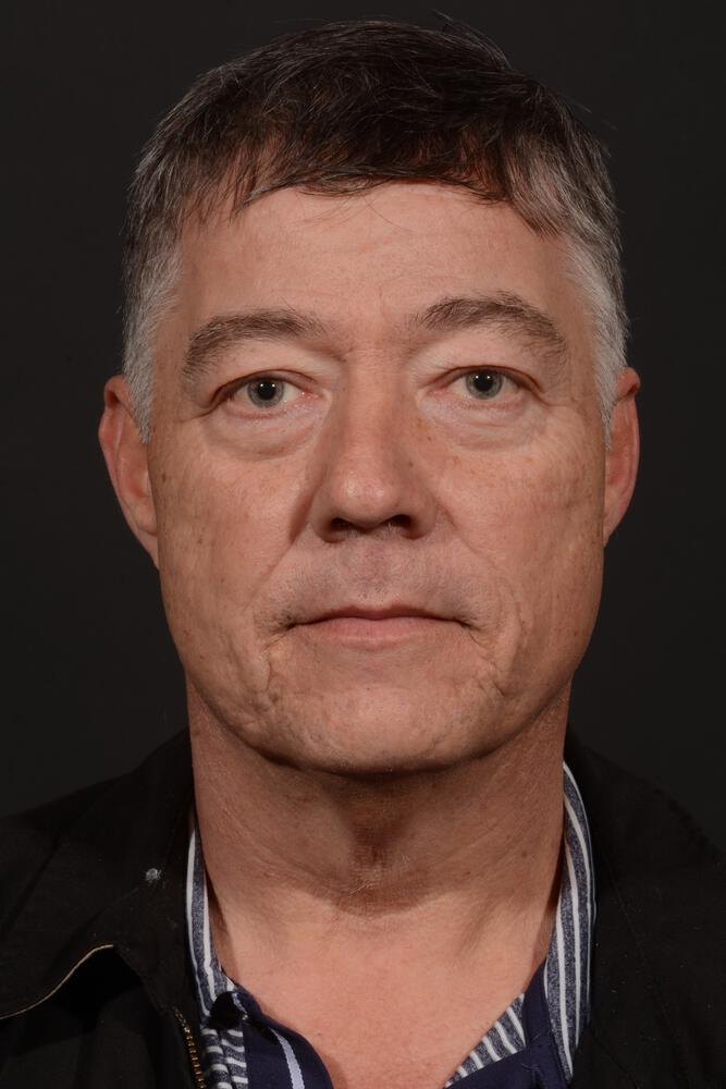 Upper Blepharoplasty Before & After Image