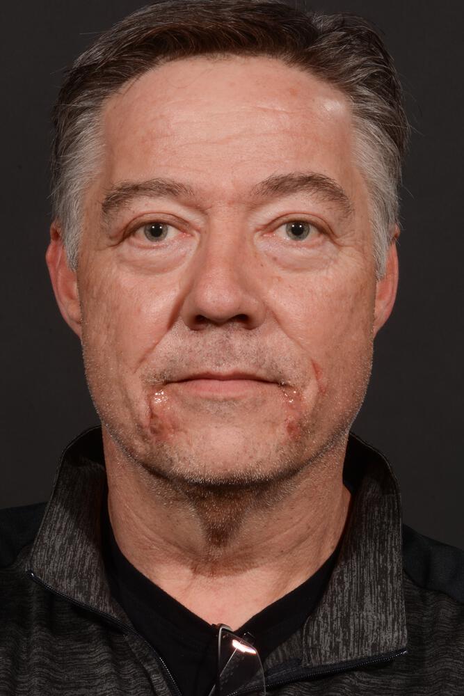 Upper Blepharoplasty Before & After Image
