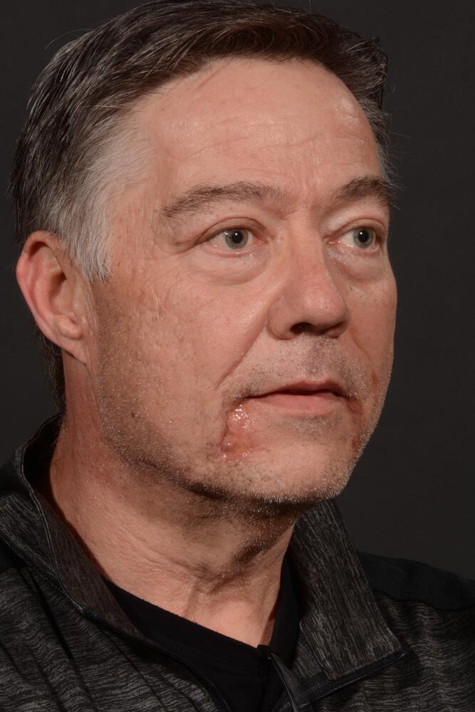Upper Blepharoplasty Before & After Image