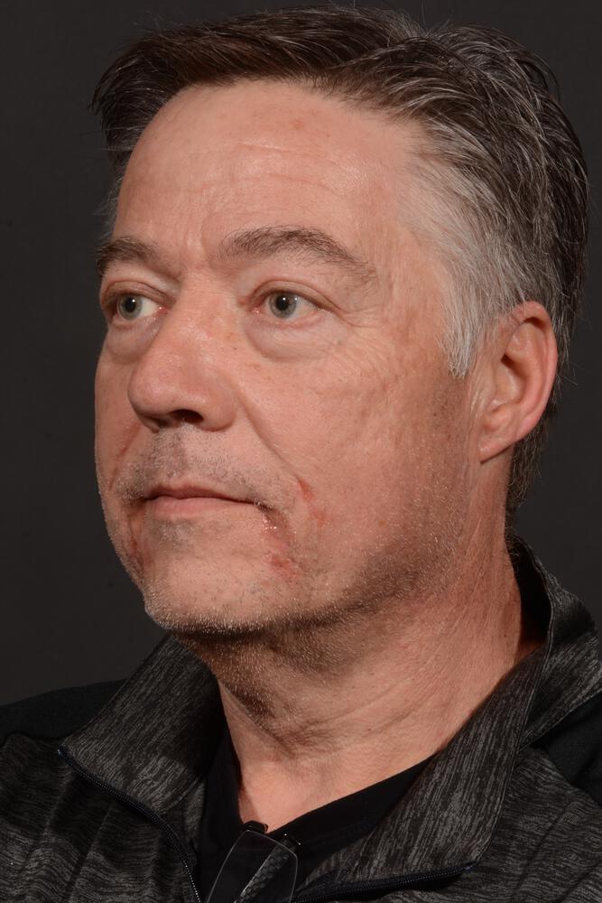 Upper Blepharoplasty Before & After Image