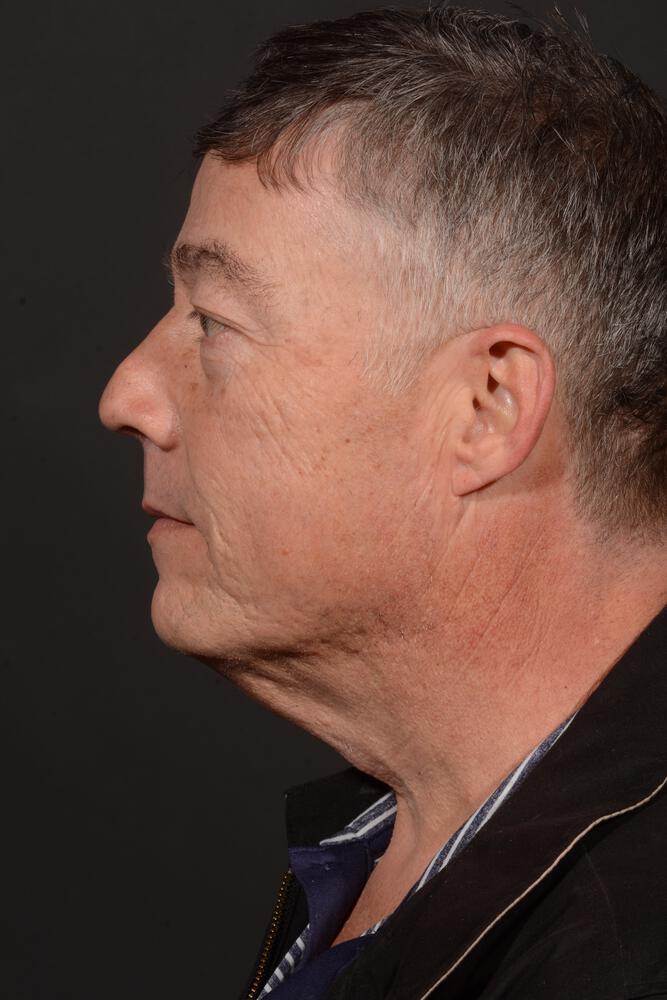 Upper Blepharoplasty Before & After Image