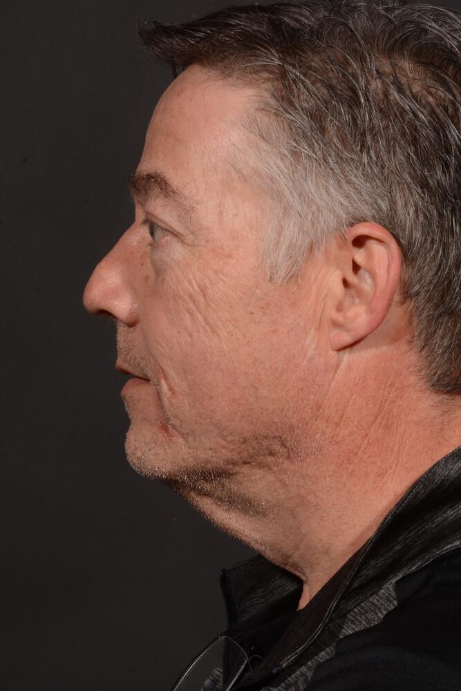 Upper Blepharoplasty Before & After Image