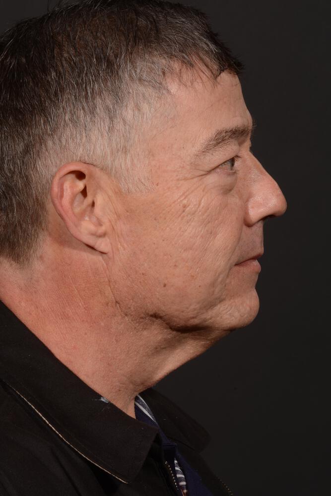 Upper Blepharoplasty Before & After Image