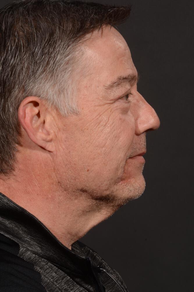 Upper Blepharoplasty Before & After Image
