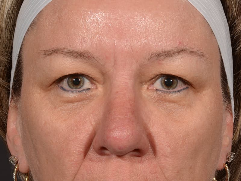 Upper Blepharoplasty Before & After Image
