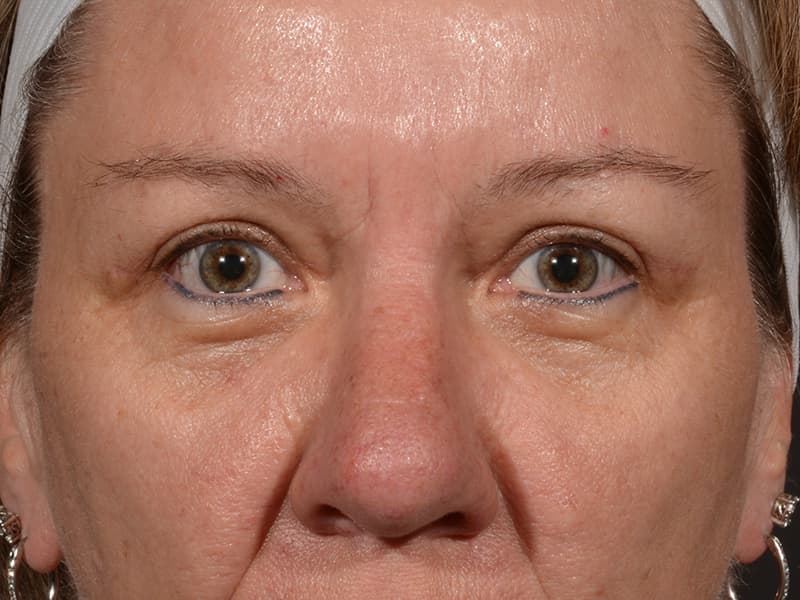 Upper Blepharoplasty Before & After Image