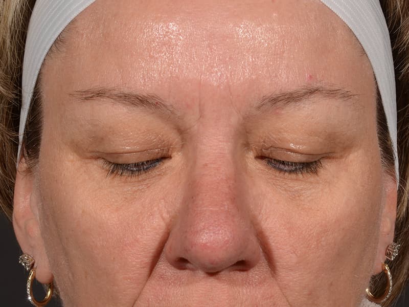 Upper Blepharoplasty Before & After Image