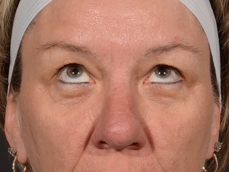 Upper Blepharoplasty Before & After Image