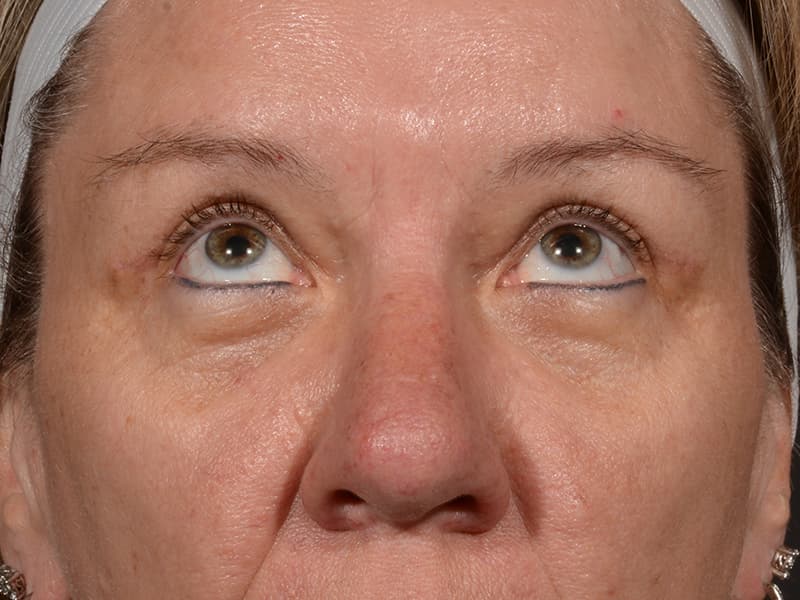 Upper Blepharoplasty Before & After Image