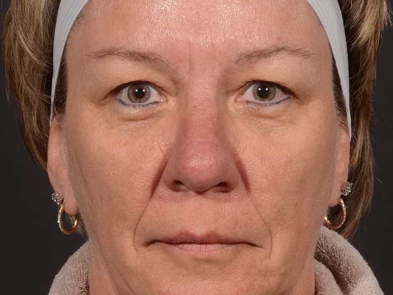 Upper Blepharoplasty Before & After Image