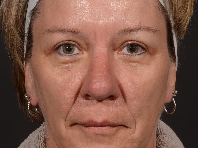 Upper Blepharoplasty Before & After Image