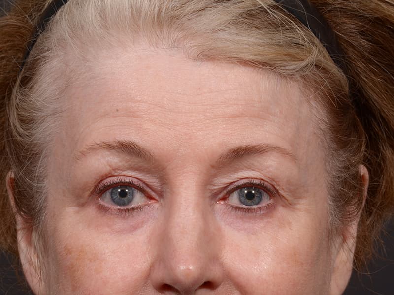Upper Blepharoplasty Before & After Image