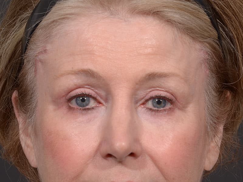 Upper Blepharoplasty Before & After Image