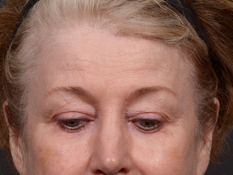 Upper Blepharoplasty Before & After Image